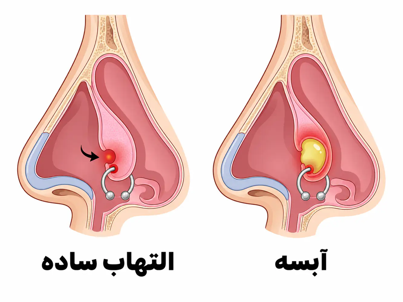 انیمیشن فرق آبسه سپتوم و التهاب ساده پیرسینگ