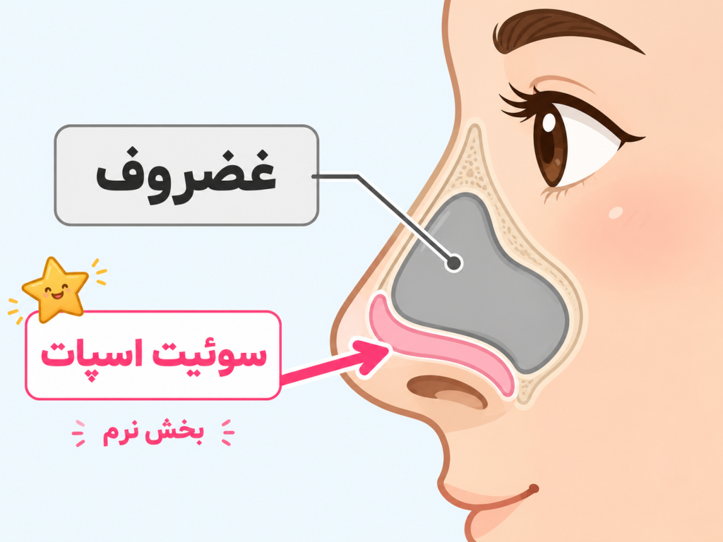 تصویر انیمیشنی آناتومی بینی و محل سپتوم با نشاندادن ناحیه sweet spot و غضروف به صورت ساده و رنگی