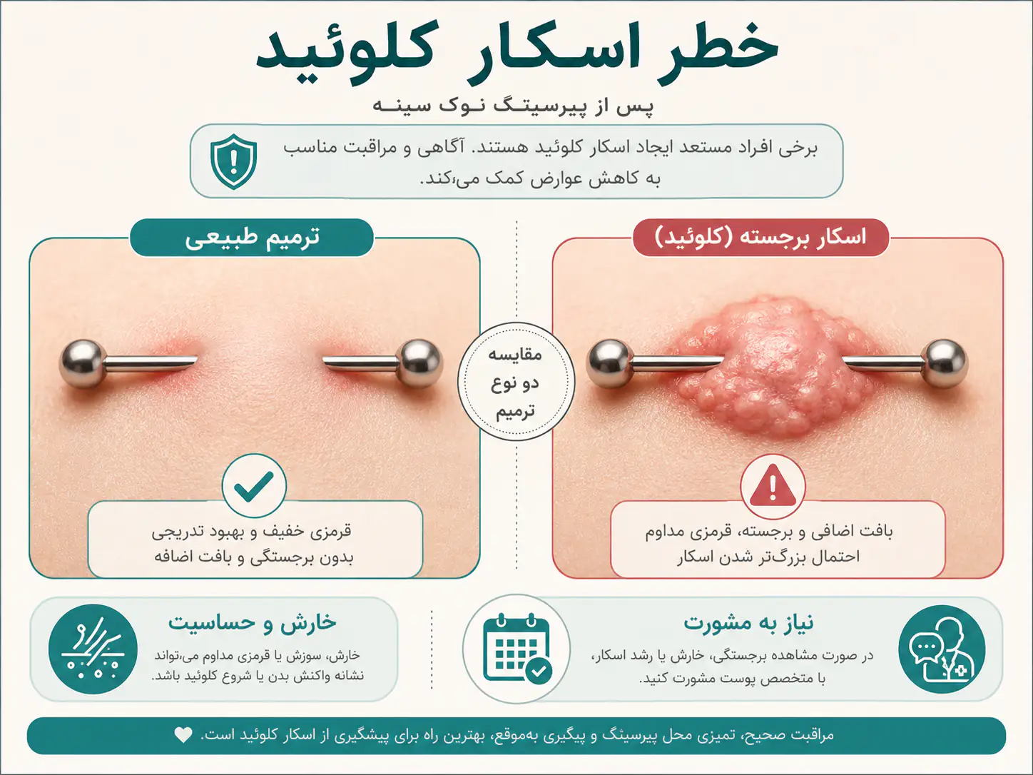 نمونه اسکار کلوئید روی پوست بعد از پیرسینگ
