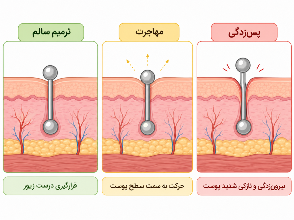 نمودار مراحل رد شدن و مهاجرت پیرسینگ ناف در پوست