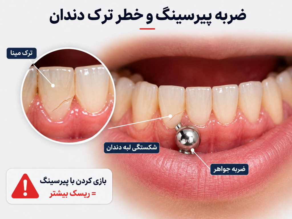 دندان ترک خورده در اثر برخورد با جواهر پیرسینگ
