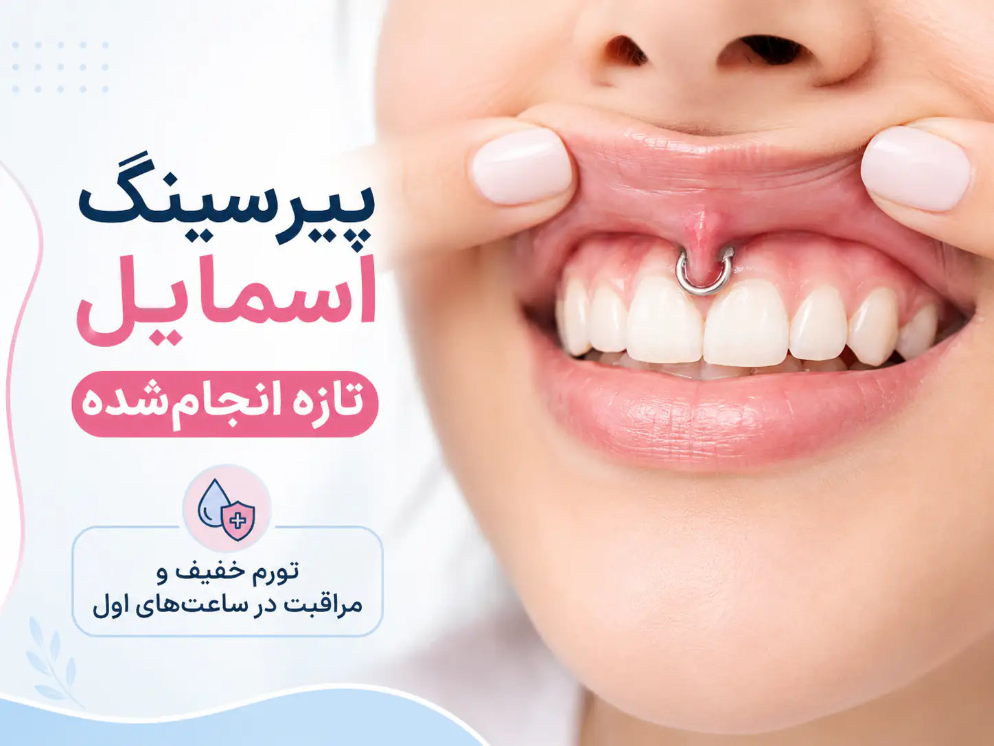 پیرسینگ اسمایل تازه انجام شده روی فرنولوم لب بالا