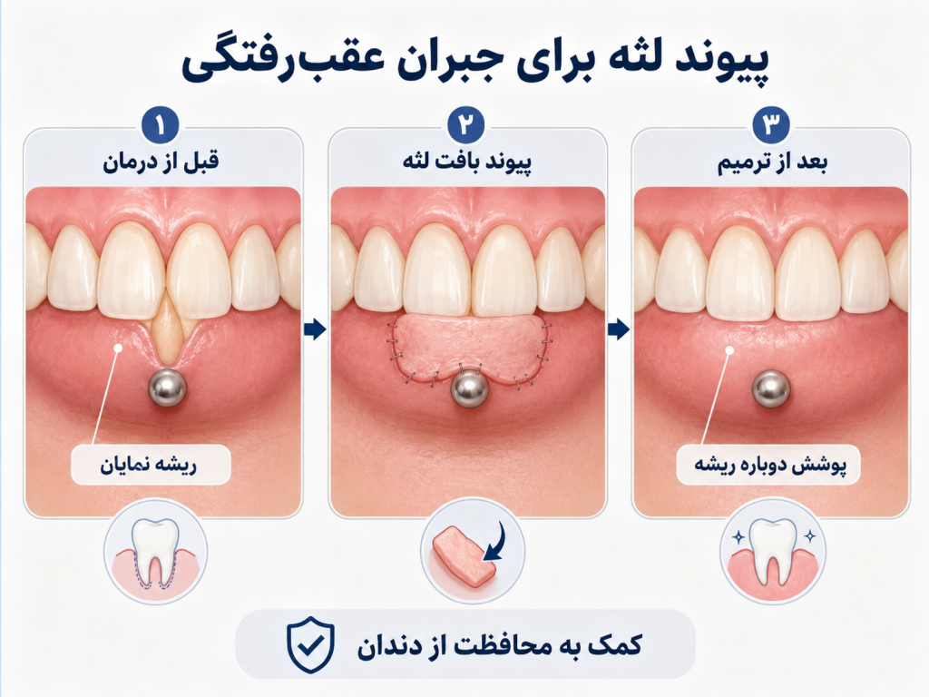 عمل پیوند لثه برای جبران عقب رفتگی ناشی از پیرسینگ