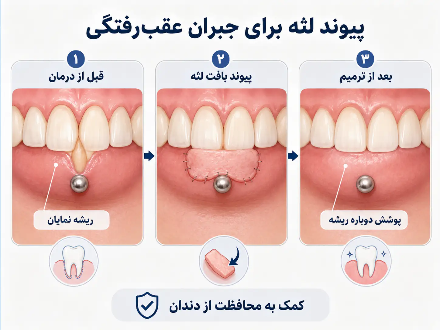 عمل پیوند لثه برای جبران عقب رفتگی ناشی از پیرسینگ