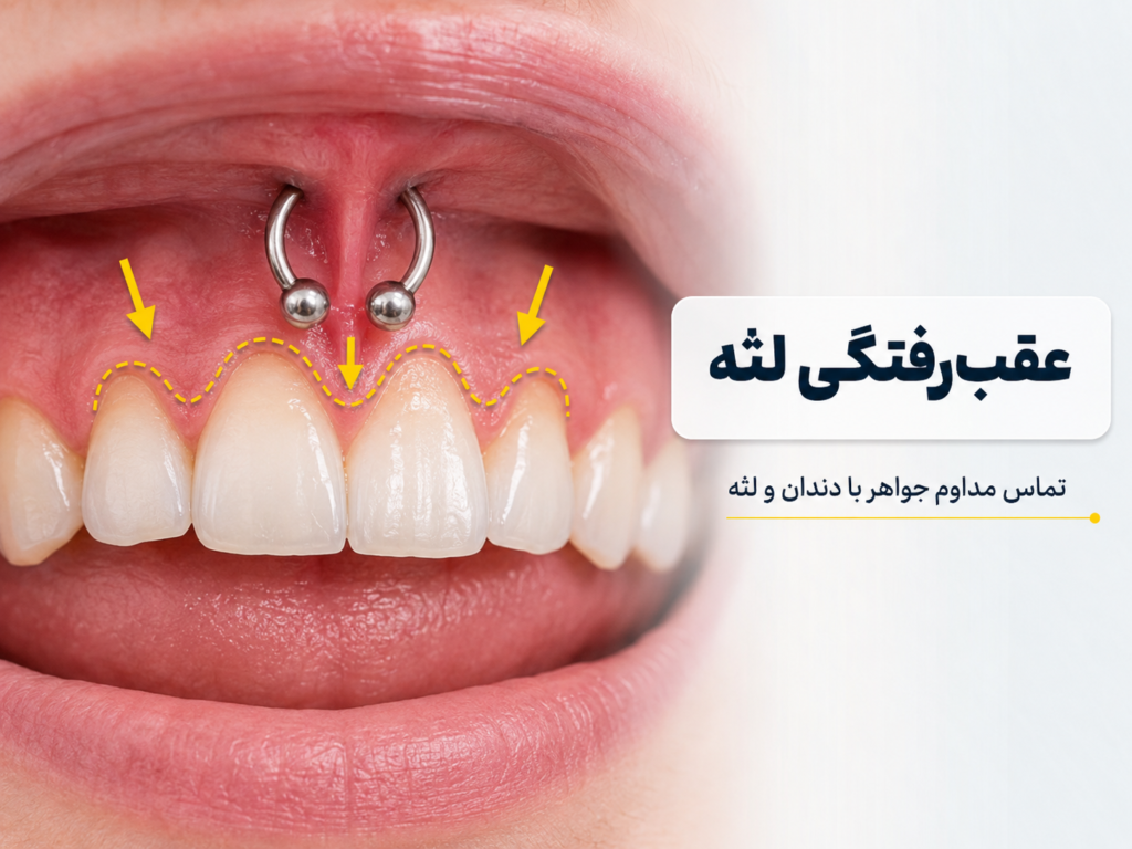 عقب رفتن لثه ناشی از تماس مداوم جواهر پیرسینگ اسمایل با دندان