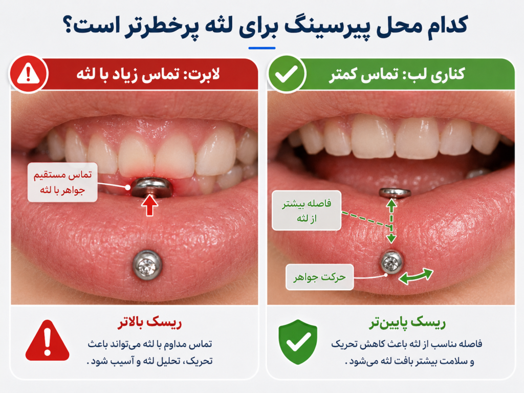 مقایسه پیرسینگ لابرت و پیرسینگ کناری لب از نظر تماس با لثه