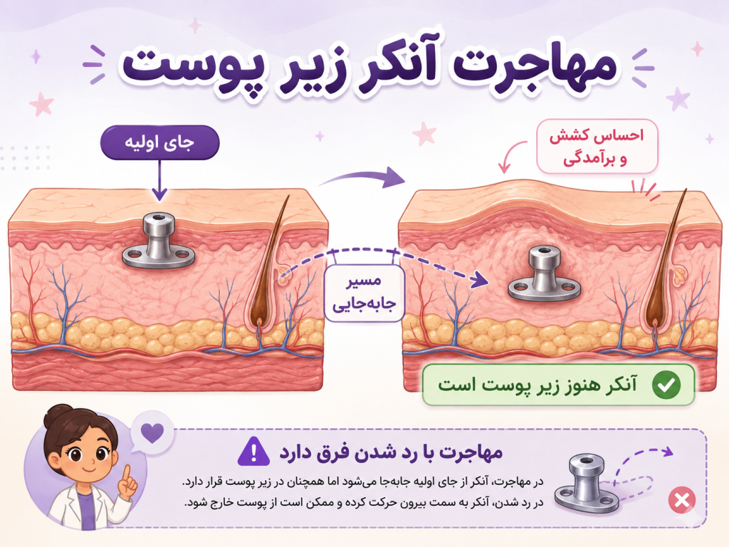 تصویر شماتیک نشان‌دهنده مهاجرت آنکر میکرودرمال زیر پوست