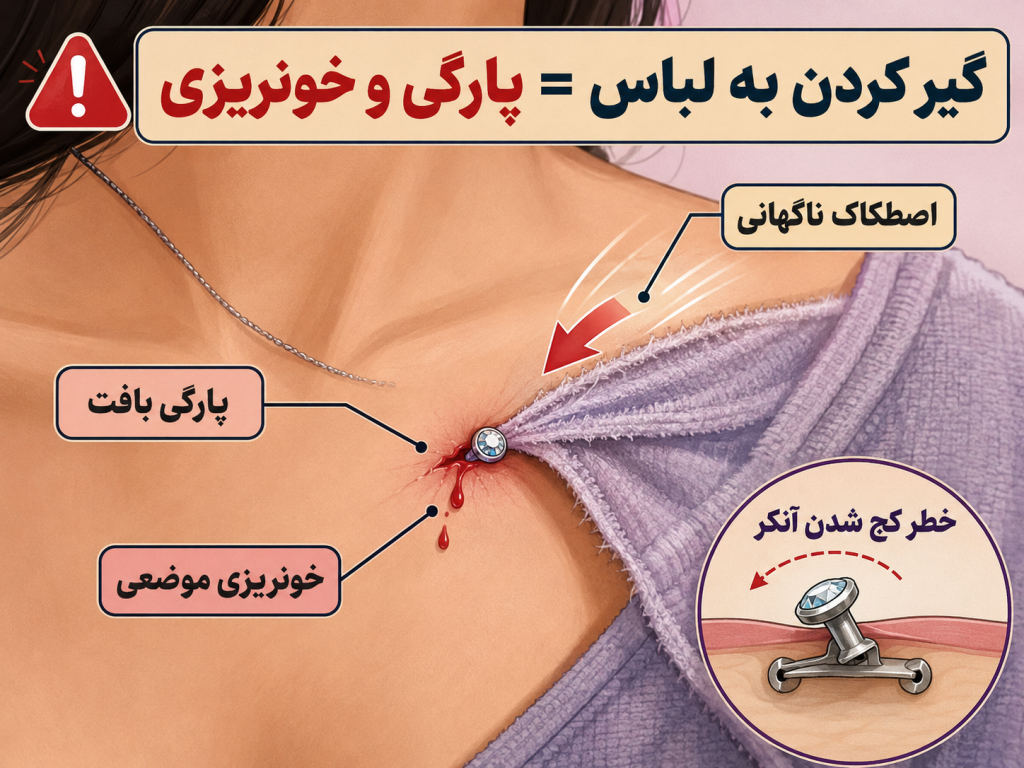 تصویر پارگی و خونریزی جزئی اطراف پیرسینگ میکرودرمال به علت گیر کردن به لباس
