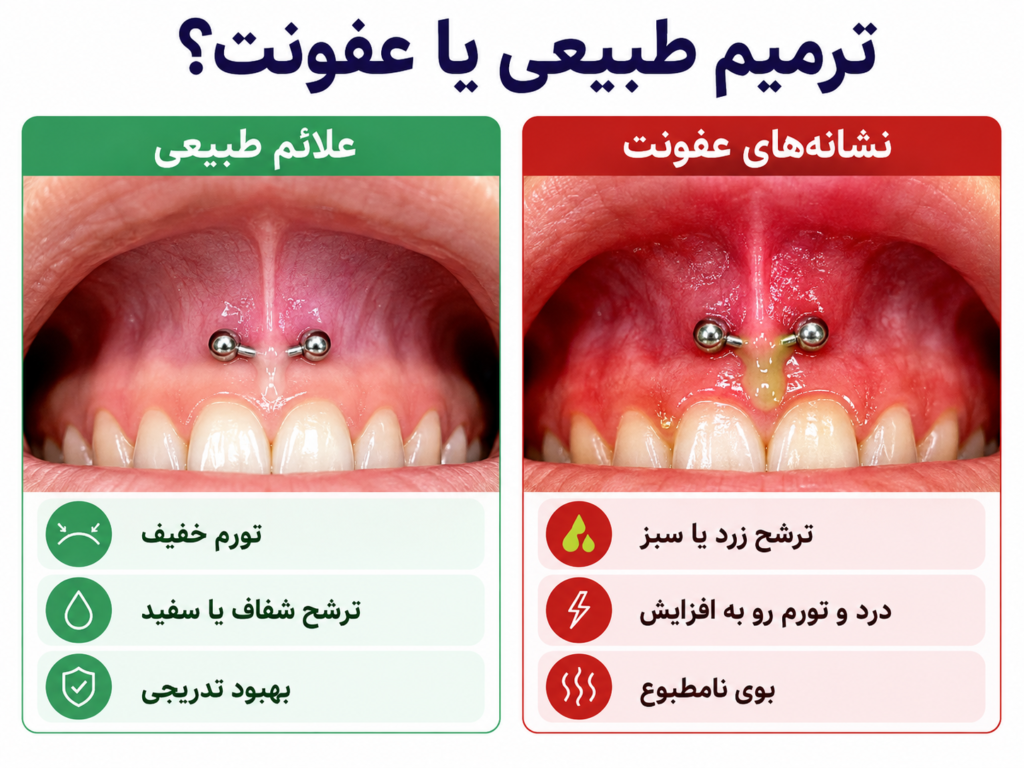 مقایسه بصری بین علائم ترمیم طبیعی و علائم عفونت در پیرسینگ اسمایل