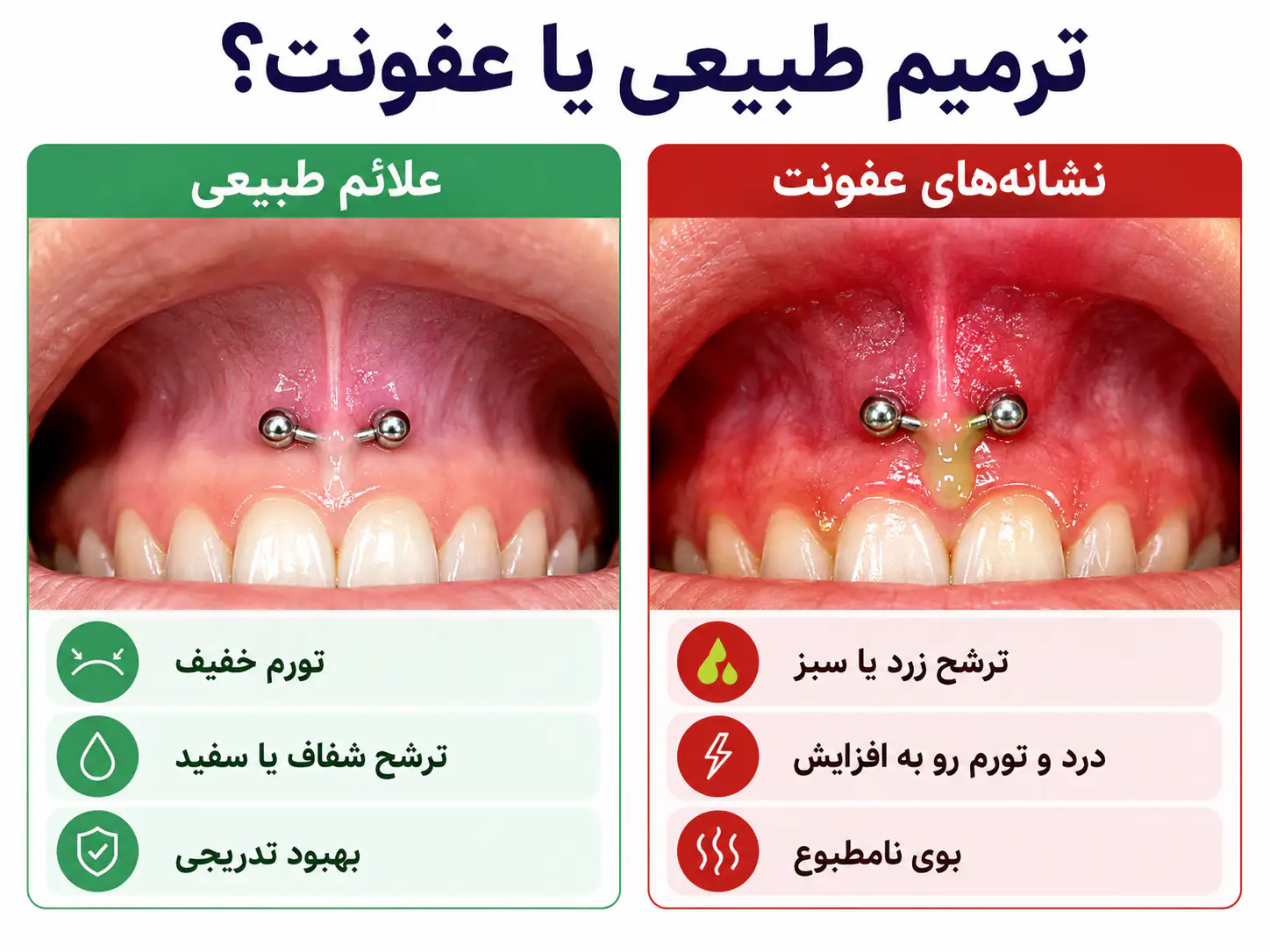مقایسه بصری بین علائم ترمیم طبیعی و علائم عفونت در پیرسینگ اسمایل