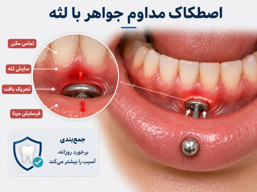 نمایش اصطکاک جواهر پیرسینگ روی بافت لثه