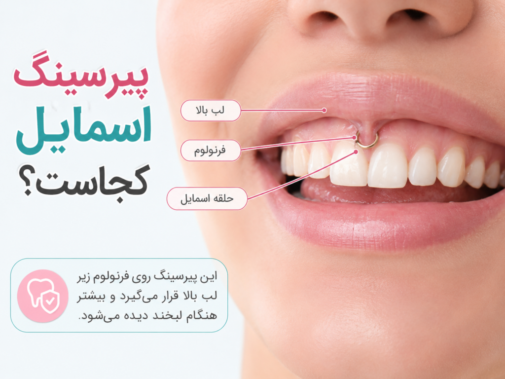پیرسینگ اسمایل روی لثه بالا زیر لب