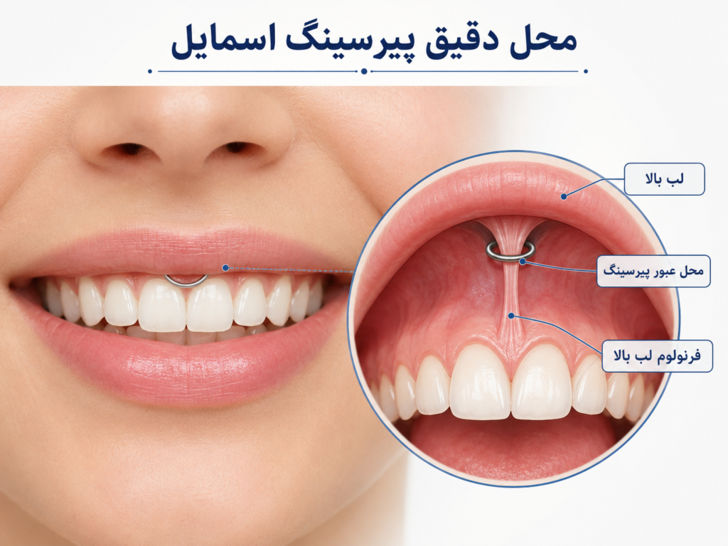 محل دقیق پیرسینگ اسمایل روی فرنولوم لب بالا