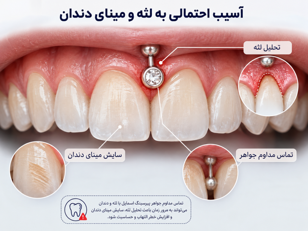 آسیب احتمالی پیرسینگ اسمایل به لثه و مینای دندان