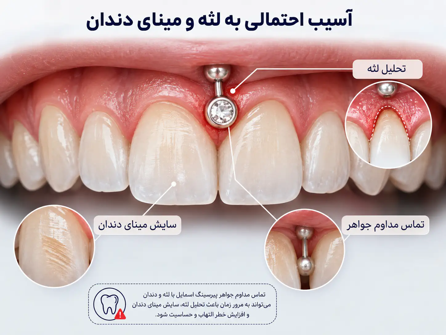 آسیب احتمالی پیرسینگ اسمایل به لثه و مینای دندان