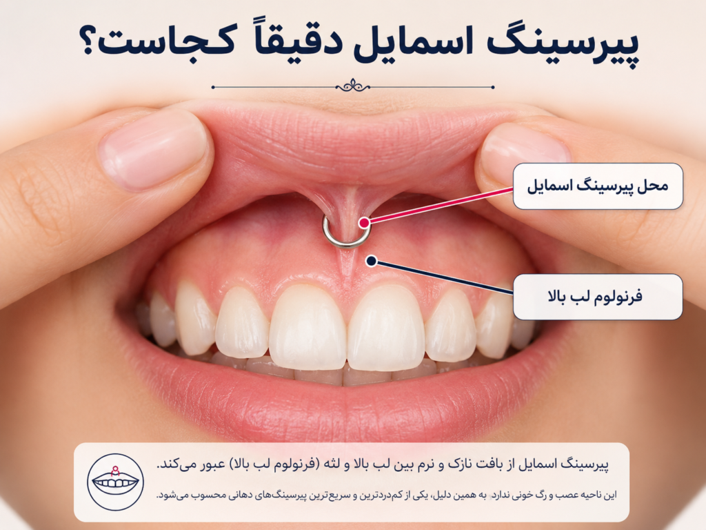 موقعیت پیرسینگ اسمایل روی فرنولوم لب بالا