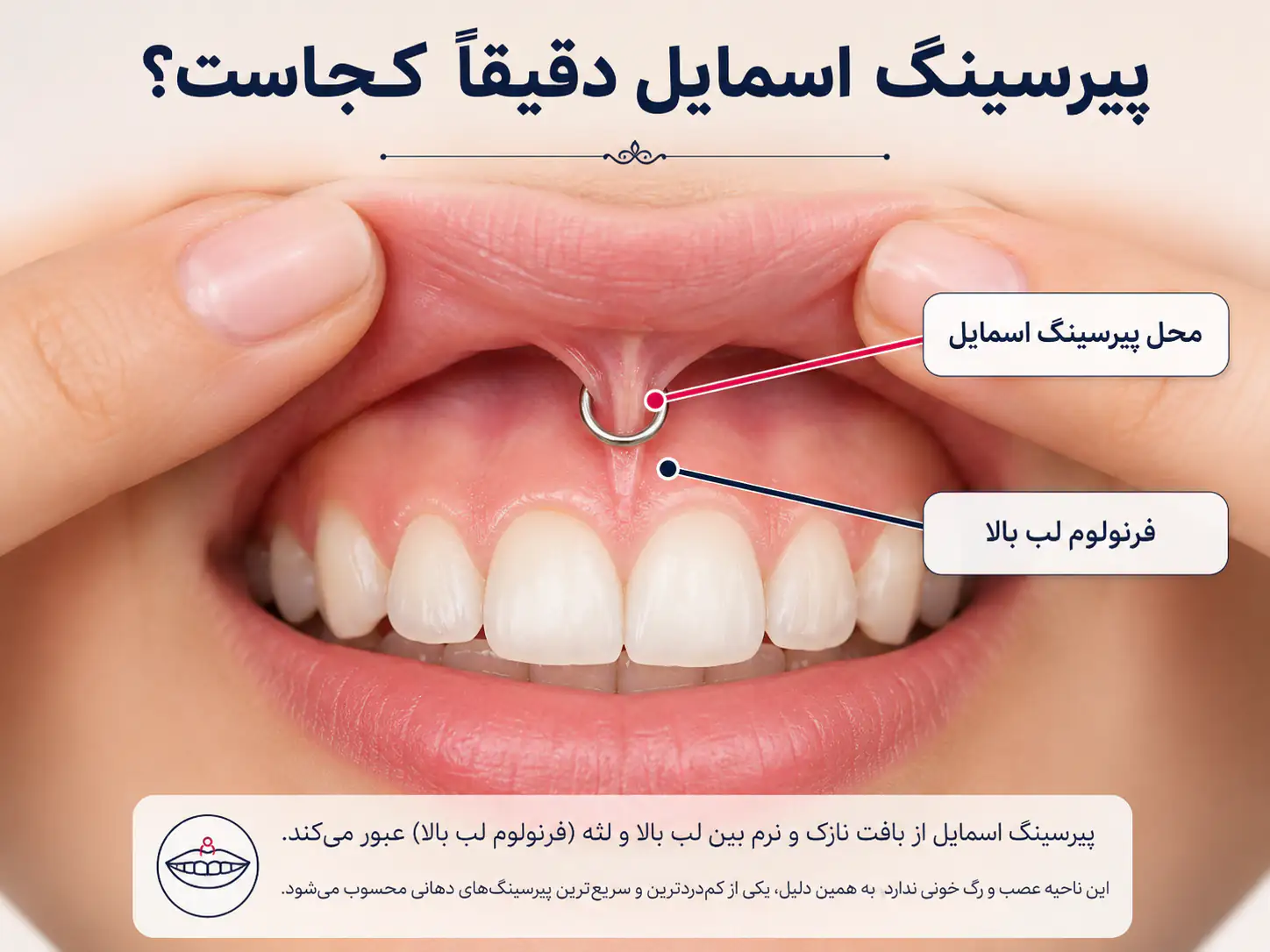 موقعیت پیرسینگ اسمایل روی فرنولوم لب بالا