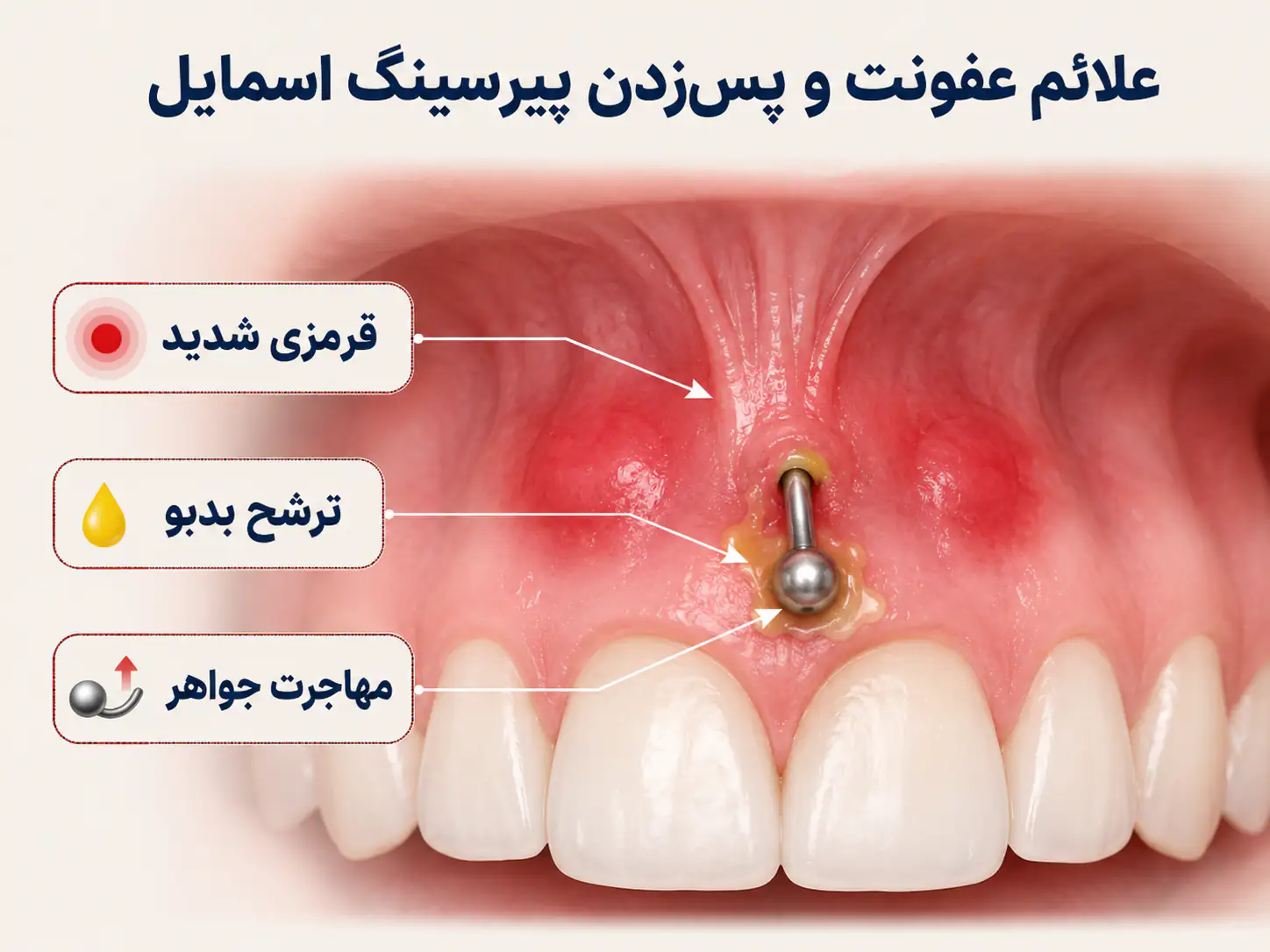 علائم عفونت و رد شدن پیرسینگ اسمایل روی لثه