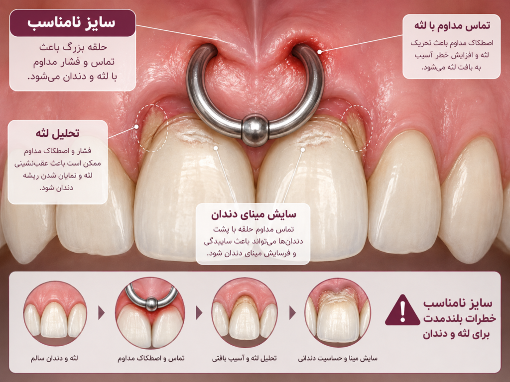 تحلیل لثه ناشی از سایز نامناسب پیرسینگ اسمایل