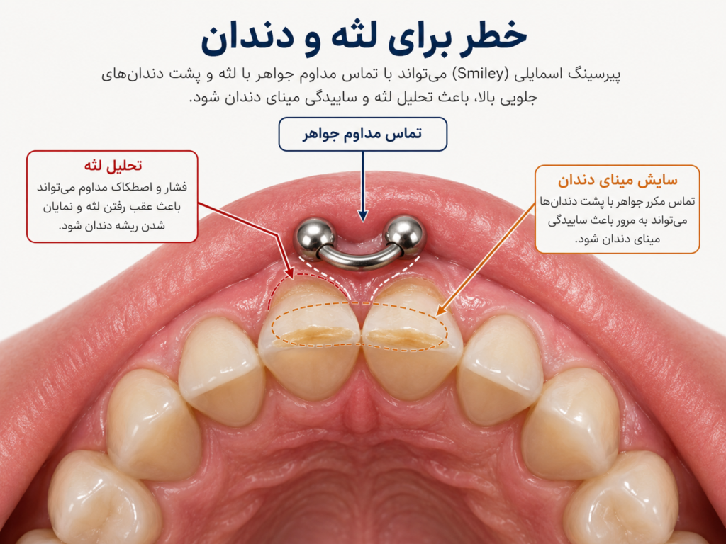 اثر تماس مداوم جواهر پیرسینگ اسمایل روی لثه و دندان جلو