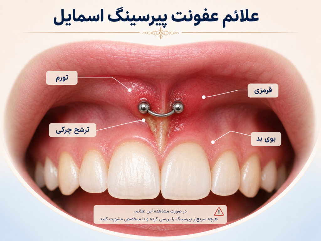 علائم عفونت پیرسینگ اسمایل شامل تورم و قرمزی