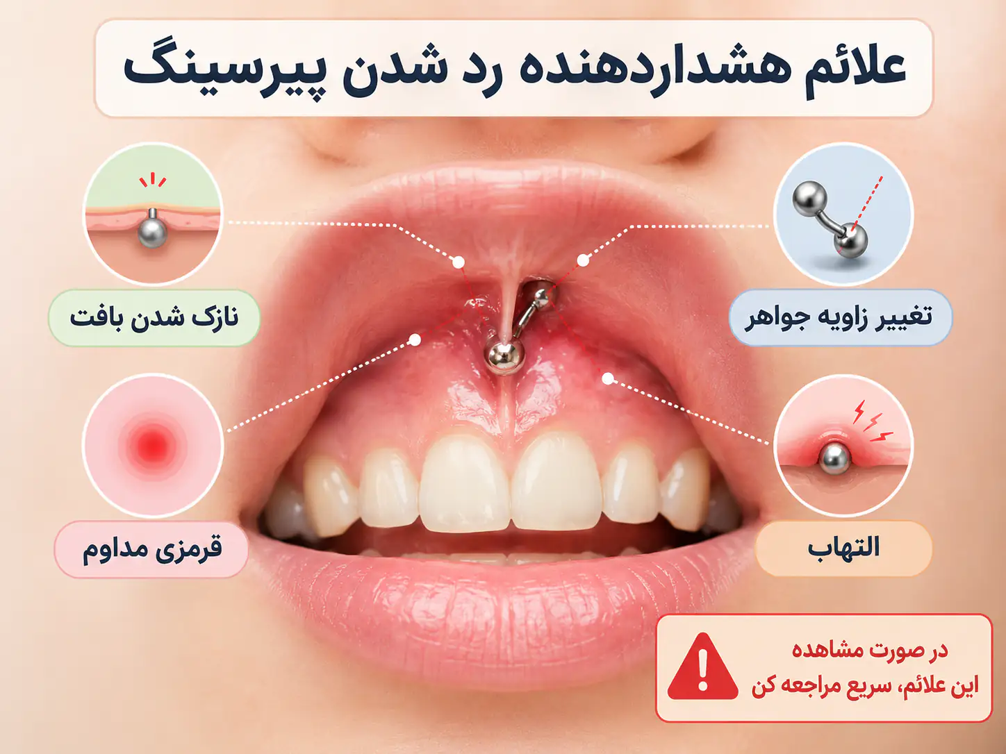 علائم هشداردهنده رد شدن پیرسینگ اسمایل