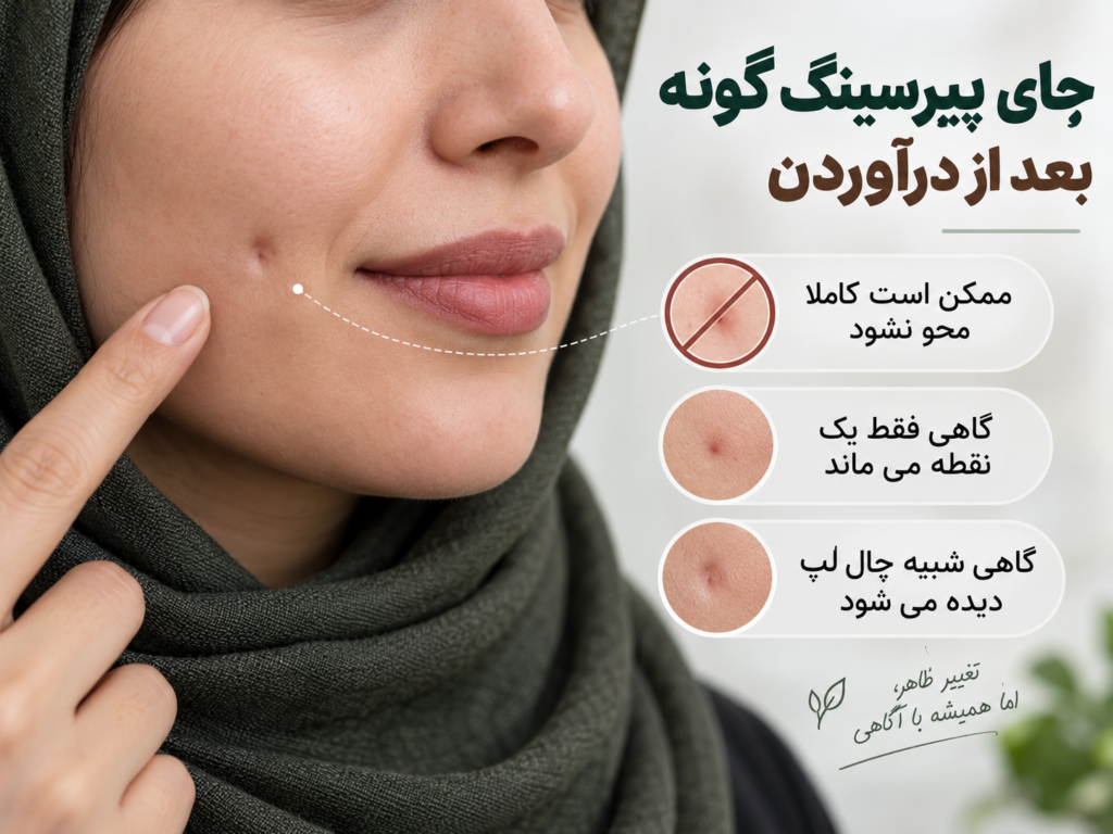 نمای نزدیک جای پیرسینگ گونه پس از خارج کردن زیور و فرورفتگی کوچک شبیه چال لپ