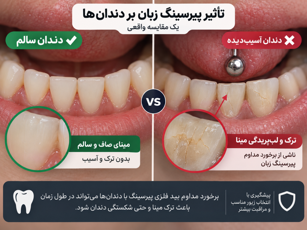 مراحل پس‌روی لثه و نمایان شدن ریشه دندان در اثر پیرسینگ زبان