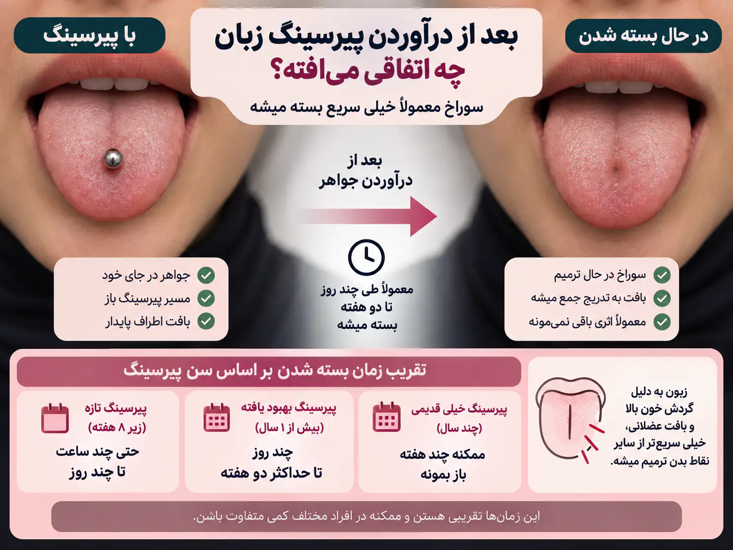 پیرسینگ زبان با گیج بزرگ که احتمال بسته نشدن کامل سوراخ را افزایش می‌دهد