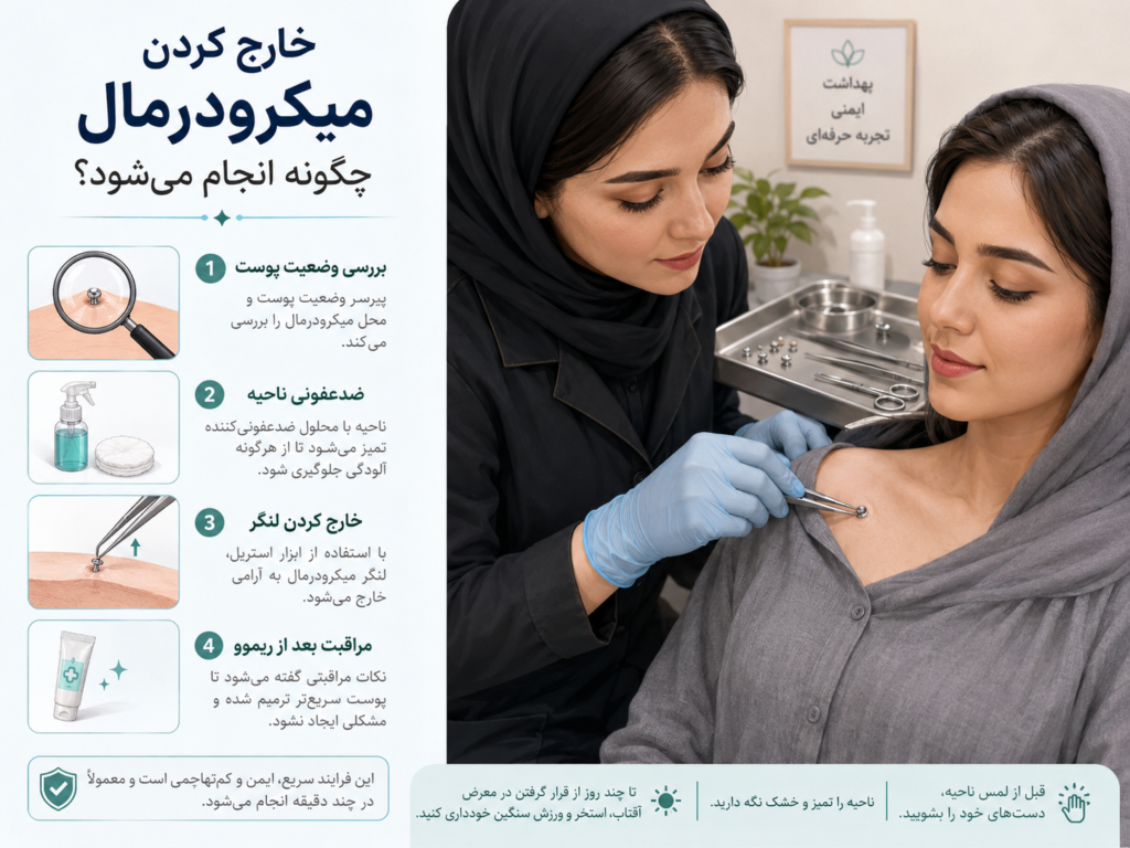 فرآیند خارج کردن لنگر میکرودرمال توسط پیرسر