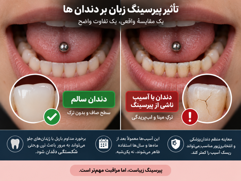 مقایسه دندان سالم و دندان دارای ترک مینا در اثر برخورد پیرسینگ زبان