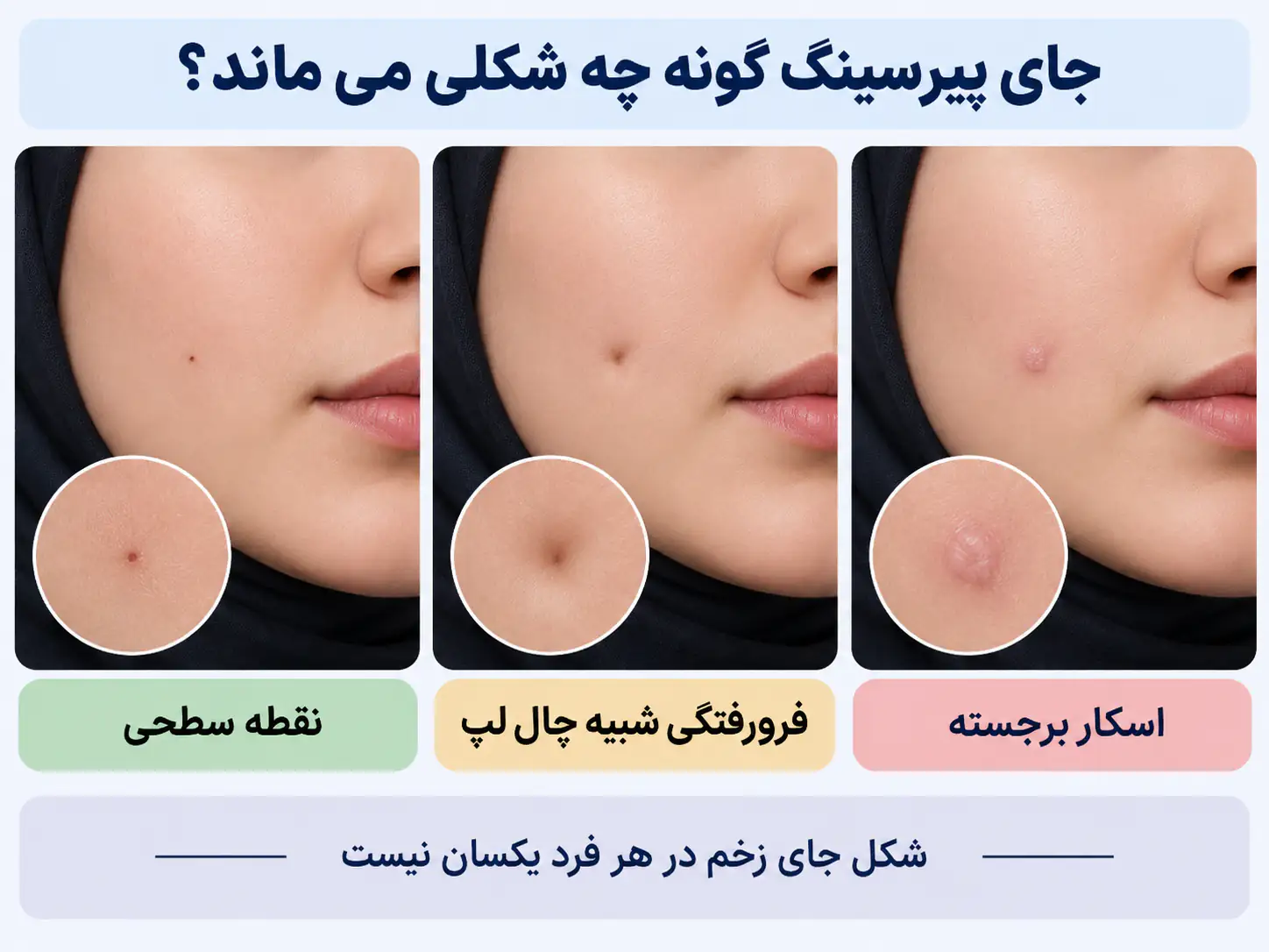 مقایسه انواع جای پیرسینگ گونه شامل نقطه سطحی، فرورفتگی شبیه چال لپ و اسکار برجسته