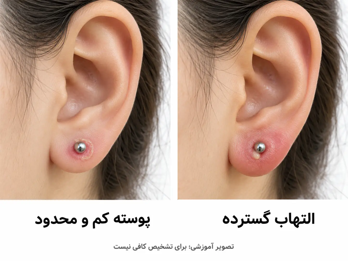 مقایسه شماتیک پوسته کم و محدود با التهاب گسترده اطراف پیرسینگ گوش