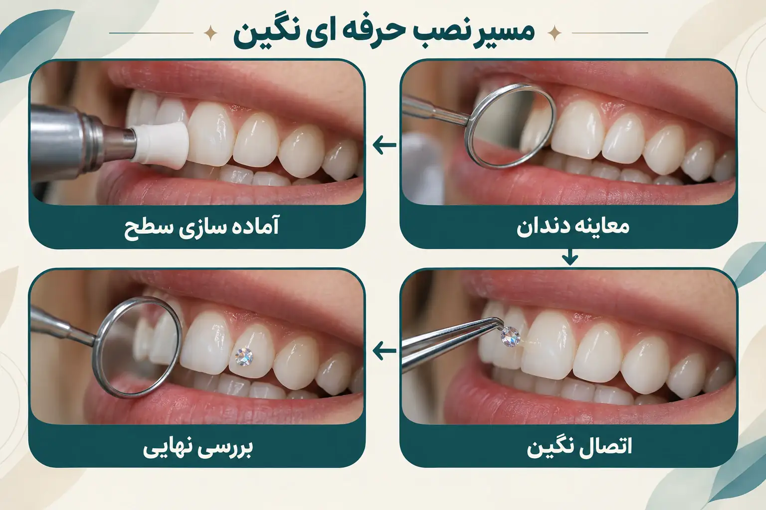 اینفوگرافیک معاینه، آماده سازی سطح، اتصال نگین و بررسی نهایی