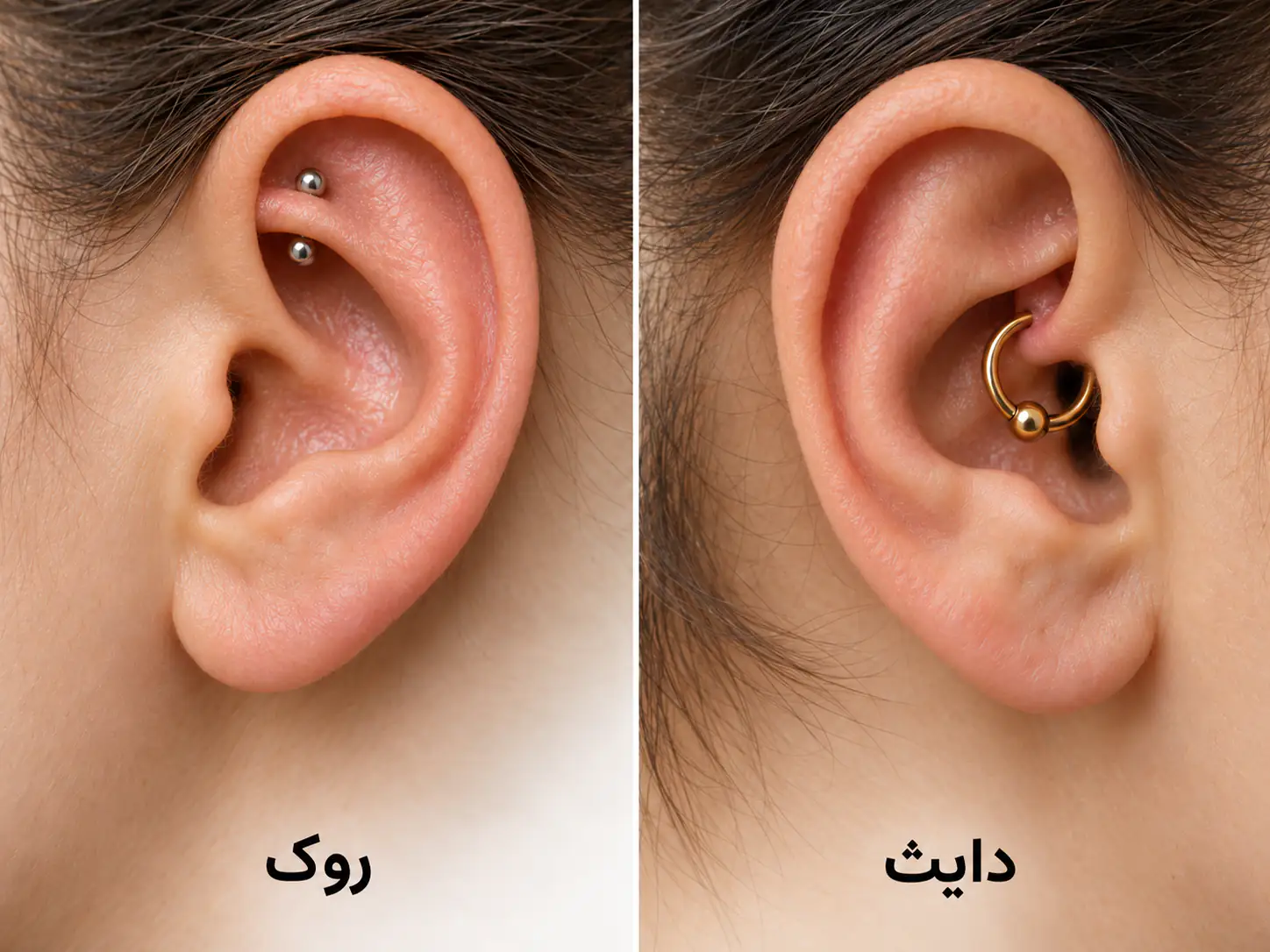 روک با میله پنهان داخل چین غضروفی بالایی و دایث با حلقه در چین داخلی گوش