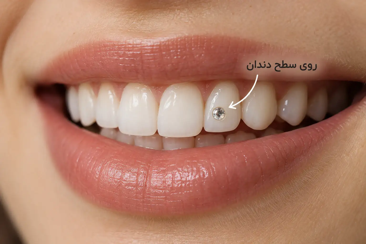 تصویر توضیحی محل نگین روی سطح بیرونی دندان جلویی