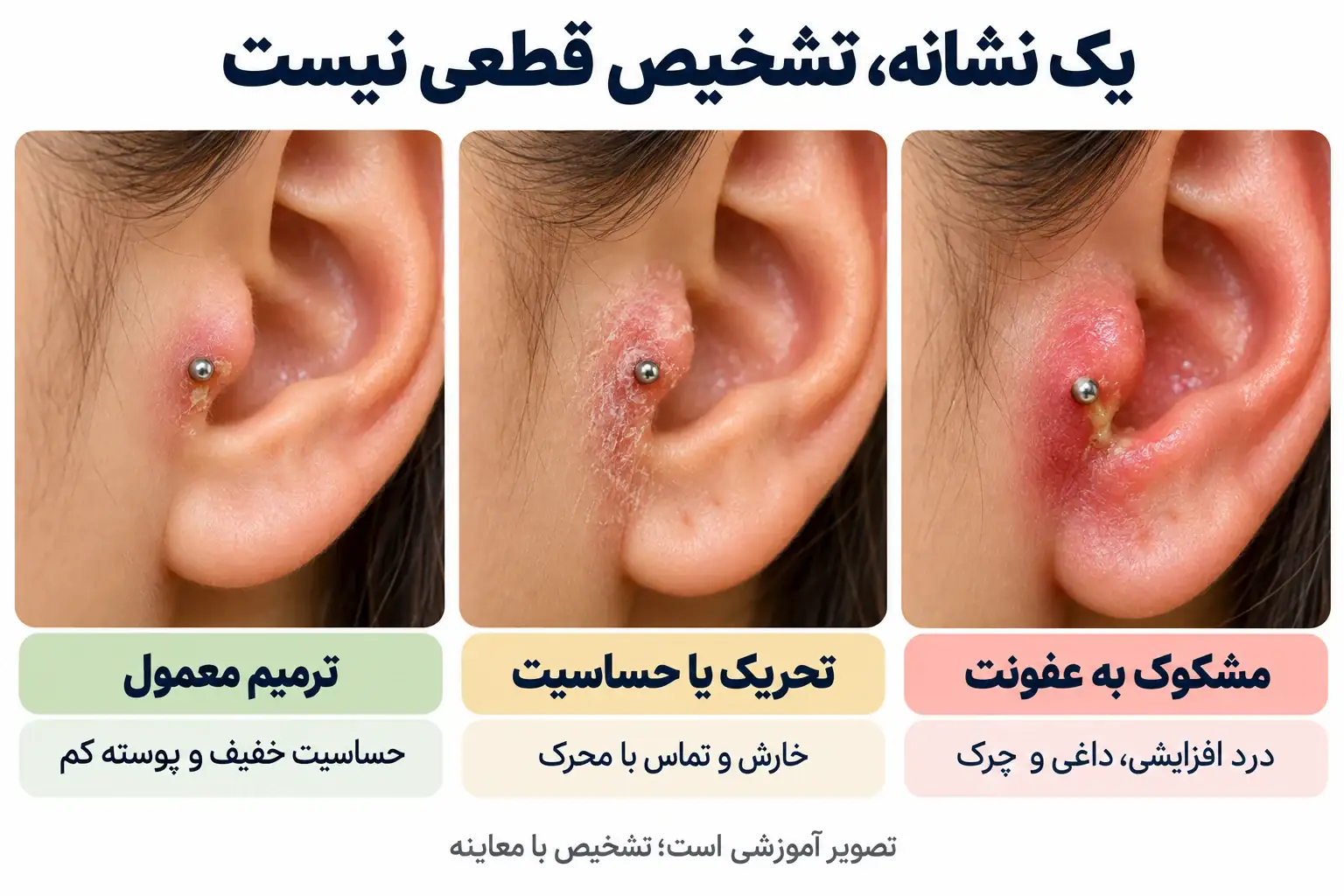 مقایسه آموزشی ترمیم معمول تراگوس، تحریک و حساسیت، و علائم مشکوک به عفونت