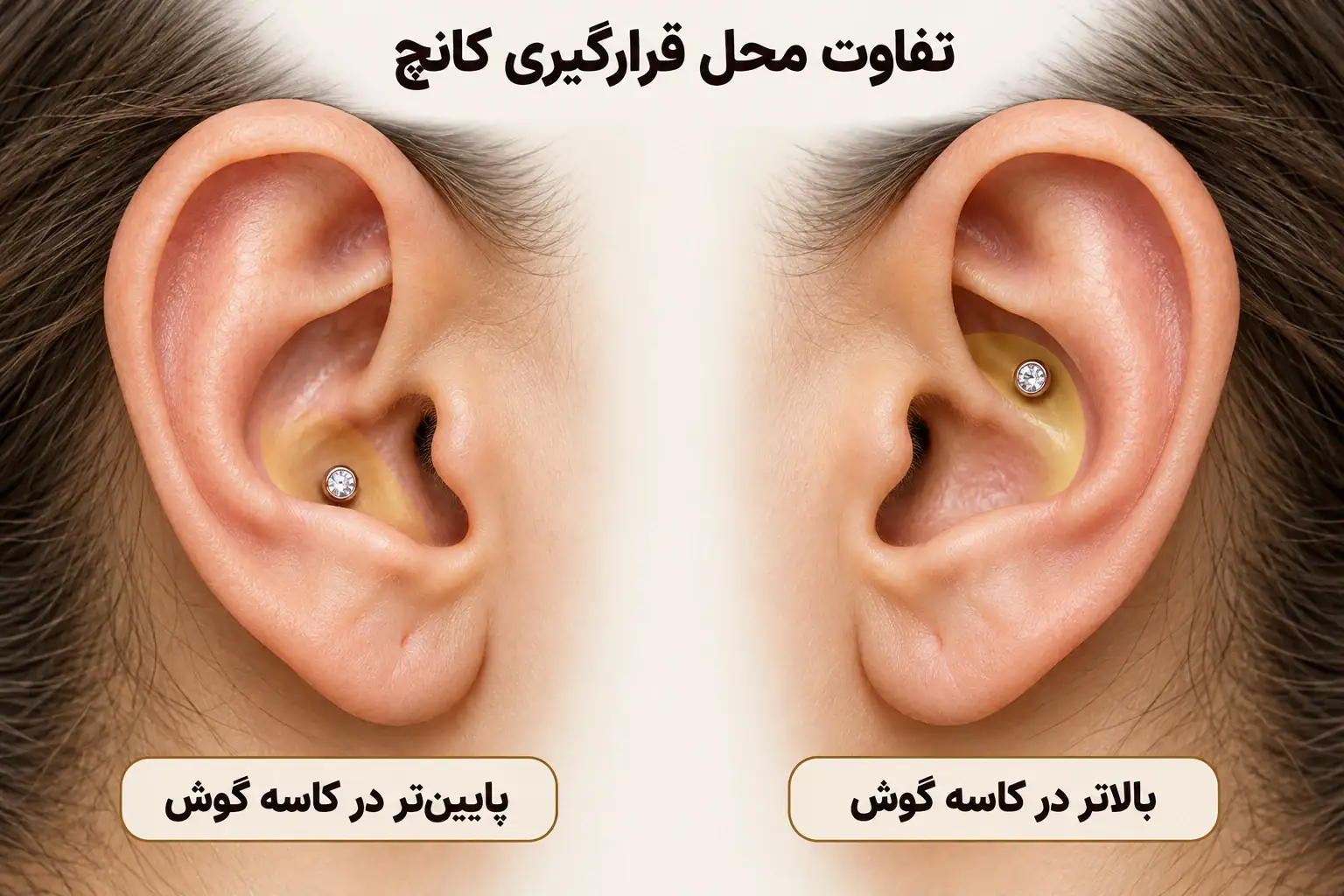 مقایسه جای پایین تر و بالاتر کانچ در کاسه غضروفی دو گوش